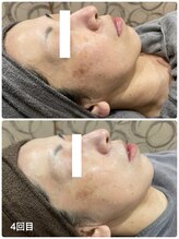 トータルビューティーサロン ヴィヴィエ(ViVier)/ホワイトケア症例4回