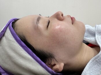 ミリミリ(milimili)の写真/敏感肌でも対応可能◎顔脱毛で素肌美を叶えるフェイシャルWAX♪ワントーン明るい肌へと導きます！