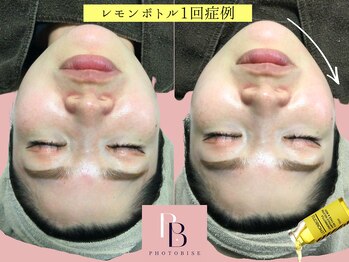 フォトビズ/レモンボトル★脂肪分解小顔矯正