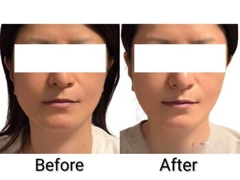 藍/レモンボトル＆プラズマ