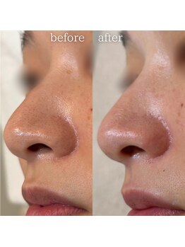 エステティックサロン ナチュラーレ/毛穴の黒ずみ・開き