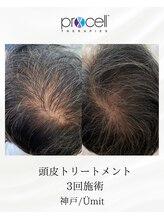 ユミト(Umit)/プロセルスカルプ