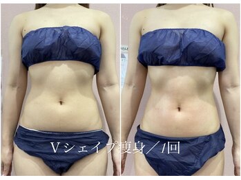 ルピナス ヒサヤ(LUPINUS hisaya)の写真/速効効果で満足度◎国内初上陸の最初マシンで頑固なお腹周りの脂肪に効く◎！《半身￥9700/全身￥15000》