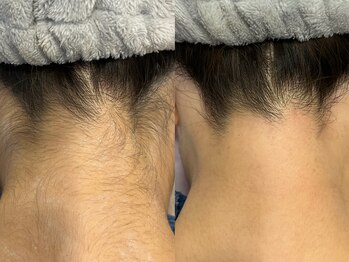 エビアス 旭川豊岡(evias)/レディース店　うなじ脱毛