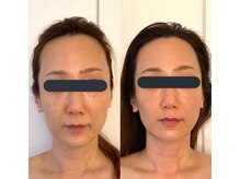 ハイコガオ(HIKOGAO)/小顔矯正40分