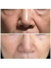 カムイ/ハーブピーリング　2回