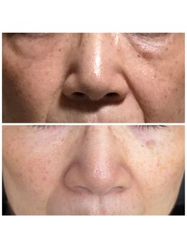 カムイ/ハーブピーリング 2回