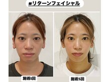 真美(Sinbi)の雰囲気（30代後半/施術5回（期間3ヶ月）ですっぴん美人に！！）