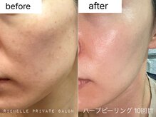 シミ・しわ・たるみなどの年齢悩みもRichelleにお任せください♪
