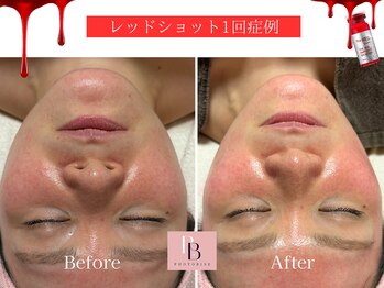 フォトビズ/もたつき二重顎たるみ改善