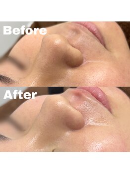 ナインオブカップス(9 of cups)/フェイシャルWaxで艶肌！