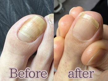 【二枚爪】フットケア大阪