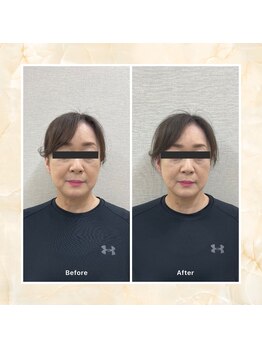プレメ 人形町院(The Preme)/くびケアスリム 1回施術後