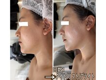 アルページュ(Arpege)/小顔×首長×肌質感から改善