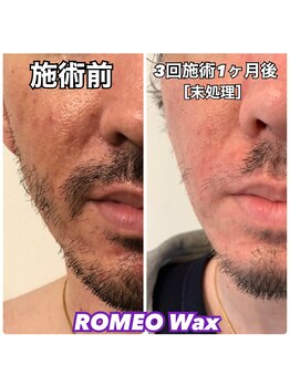 ロミオワックス 渋谷店(ROMEO Wax)/メンズ☆ヒゲ光脱毛経過写真