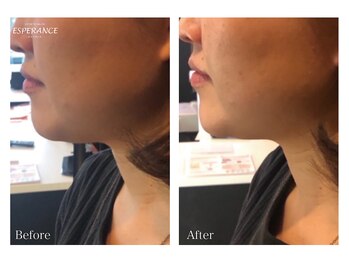 エステティックサロン エスぺランス(ESPERANCE)/フェイスラインのもたつきを改善