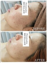 リセラージュ(Recellage)/陶肌トリートメント/ニキビケア