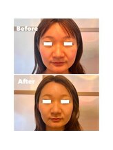 ティアラ(TIARA)/【小顔、たるみ】テラボーラー