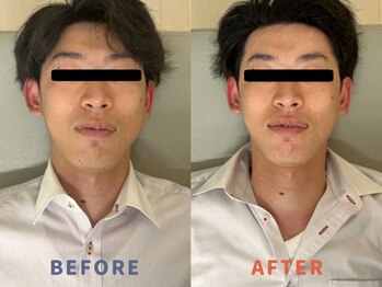 ククナ 新横浜駅前サロン/小顔矯正ビフォーアフター　