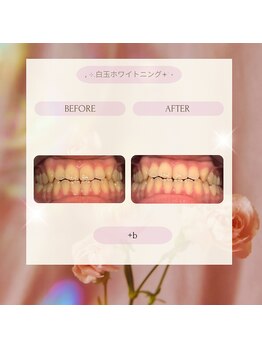プラスビー 2号店(+b)/ホワイトニングビフォーアフター
