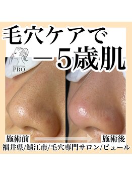 ピュール 鯖江店(PUR)/毛穴/毛穴ケア/毛穴洗浄