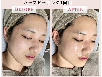 レクラ バイ ドクターエイチ(L'ECLAT by Doctor.H)/ハーブピーリング