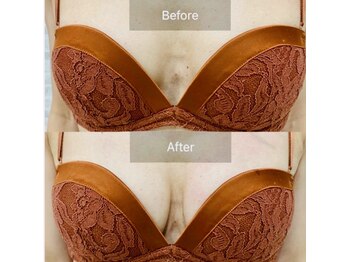 ラピス(LAPIS)/バストアップ美肌BBL