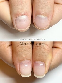 マリーロール 淀屋橋本店(Marie Laure)/自爪育成/深爪矯正/ネイルケア
