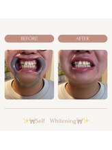 サロンエピ(Salon Epi)/セルフホワイトニング