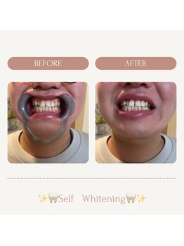 サロンエピ(Salon Epi)/セルフホワイトニング