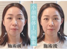 ハル(Haru)/小顔整体施術1回