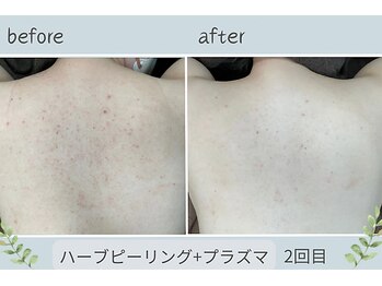 ウェルビー(Well-Be)/ハーブピーリング＋プラズマ導入