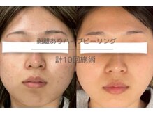 ヒジ(Life Salon)/ハーブピーリング/ララピール