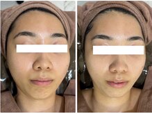 ホワイトアクア 四日市店(WHITE AQUA)/エステ四日市/ハーブピーリング