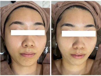 ホワイトアクア 四日市店(WHITE AQUA)/エステ四日市/ハーブピーリング