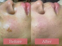 フローラ(FLORA)/シミケアBeforeAfter