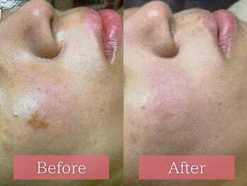 フローラ(FLORA)/シミケアBeforeAfter