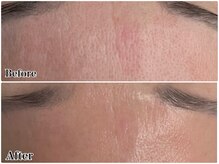 エミマス ボーテ(Emimas Beaute’)/つるんと整ったキレイなおでこ