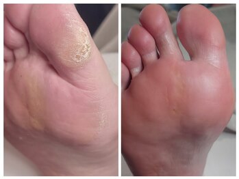 アンティ(Aunty)/親指と足裏のタコ(胼胝)