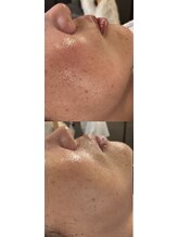 白の雫/赤ら顔の変化