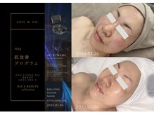 オーヴォ リビングスパ アネックス マノン(OVO LIVING SPA annex MANON)/【施術事例】肌改善プログラム