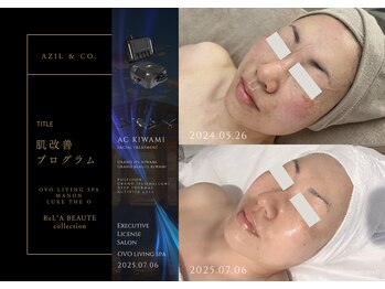 オーヴォ リビングスパ アネックス マノン(OVO LIVING SPA annex MANON)/【施術事例】肌改善プログラム