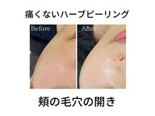 エヌアイビューティー 積志店(N eye beauty)の雰囲気（植物幹細胞の力で結果重視のハーブピーリング♪※詳細はブログ）