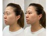 《圧倒的効果!!》【悩み：顔のたるみケア全て】ハーブ2g+リフトアップ120分