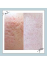 ラシュレ(BEAUTY CONCIERGE RASSURER)/ニキビ、赤み、凸凹にND-R！