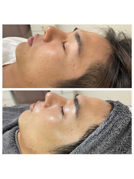 レミリー(Lemiry)/ハーブピーリング