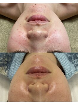 レイ(Lei)/ニキビ/毛穴/ハーブピーリング