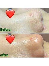 ビービー(BB)/#毛穴洗浄