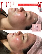 フォトビズ/レッドショット二重顎たるみ改善