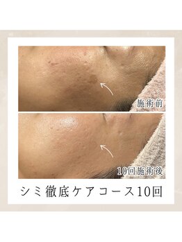 エンルーチェ(enluce)/【天六・梅田】シミケア